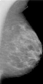 Mammogram